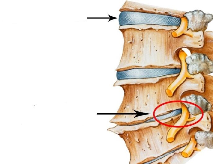 Oštećeni disk i prekršeni živac s cervikalnom osteohondrozom